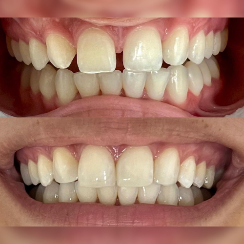 Antes e depois de um tratamento com facetas de resina, exemplo real